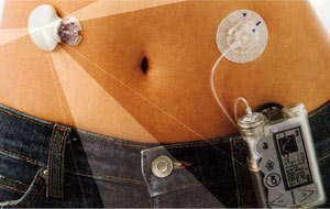 Medtronic Revel Continuous Glucose Monitor